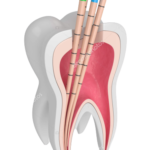 Canal de Dente