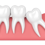 Extração de 3º Molar